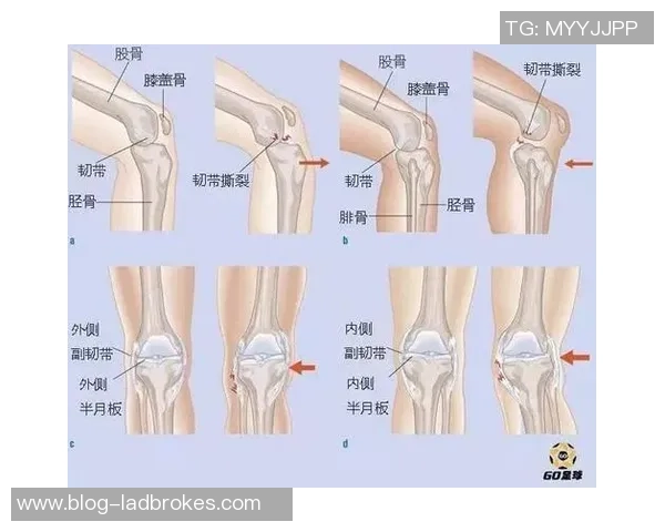足球压膝盖的危害与预防措施探讨如何保护运动员的膝关节健康 足球压膝盖的危害与预防措施探讨如何保护运动员的膝关节健康